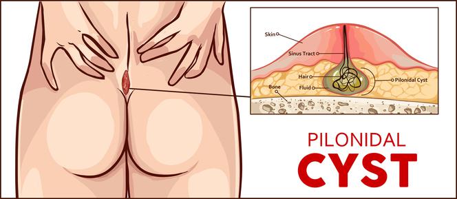 odparzenie na kosci ogonowej od pieluchy